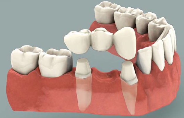 Dental Bridge